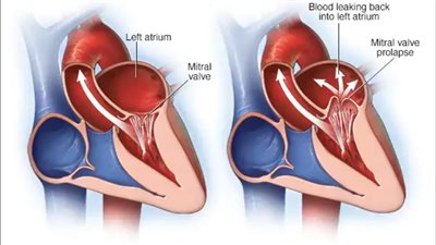 أمراض الصمام الميترالي.. الارتخاء اشهرها بين النساء