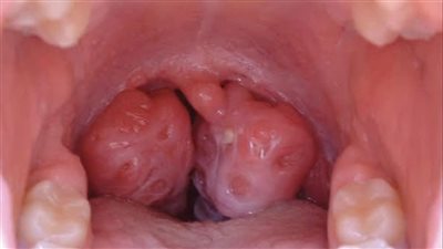 التهاب اللوزتين.. متى يكون استئصالهما ضروريا؟