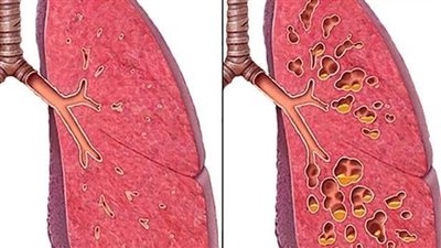 تليف الرئة.. الاسباب والاعراض وطرق العلاج 