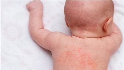 خبير يكشف طريقة الحماية من الإصابة بحمو النيل