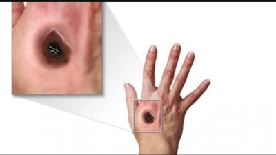 بعدما تصدرت التريند.. أبرز ما يسبب تسمم الجمرة الخبيثة