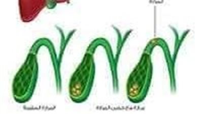 ماذا يأكل مريض المرارة؟.. الخضروات الورقية وصدور الدجاج