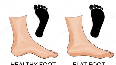 الفلات فوت.. علاج متلازمة القدم المسطحة