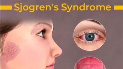 علاج متلازمة شوجرن.. الكورتيزون والماء والسوائل 