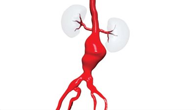 السعودية.. 3 ساعات جراحية لإنقاذ مريض من انفجار شرايين البطن