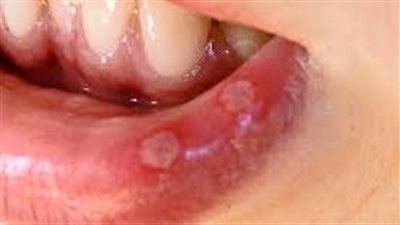 علاج تقرحات الفم في المنزل.. الماء المالح وصودا الخبز 