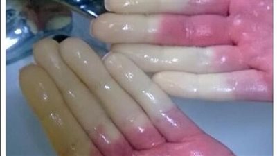 متلازمة رينود.. الاعراض والاسباب وطرق العلاج