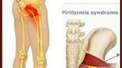 متلازمة العضلة الكمثرية.. ماذا تعرف عن عرق النسا الكاذب؟