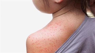 علاج حمو النيل للكبار في المنزل.. وسائل طبيعية بالنشا والليمون وزيت الزيتون