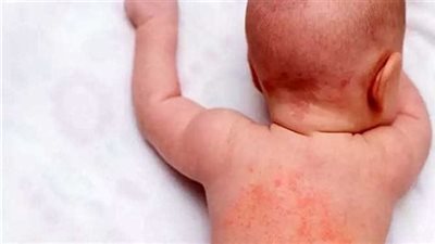 كريم لعلاج حمو النيل للأطفال.. 5 أنواع لتخفيف الالتهاب والحكة