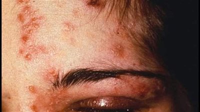 علاج الحزام الناري.. مضادات الفيروسات تساعد في تقليل مدة المرض