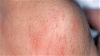 علاج حمو النيل من الصيدلية.. اكثر مشكلة جلدية فى الصيف 