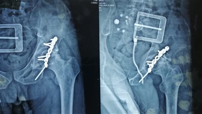السعودية.. 8 ساعات جراحية لترميم حوض كسره مفصل صناعي في منطقة حائل