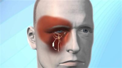 أسباب الصداع العنقودي وأعراضه.. والمضاعفات المحتملة