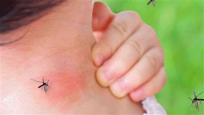 11 طريقة لـ علاج لدغة الحشرات في المنزل.. إسعافات أولية للحكة 