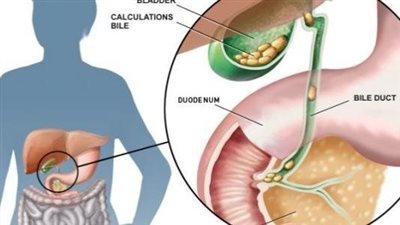 الطعام المناسب بعد استئصال المرارة.. الخضروات والفواكه الانسب لك