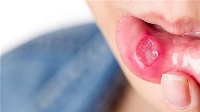 فطريات الفم .. الاعراض والاسباب وطرق الوقاية