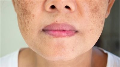 كلف الحمل.. ما هو واعراضه واسبابه؟ 