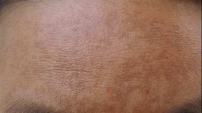 أنواع كلف الحمل وطرق الوقاية منها