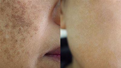 كيفية تشخيص كلف الحمل وطرق العلاج