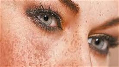 وصفات طبيعية لتخفيف كلف الحمل.. بعصير البصل والحليب 