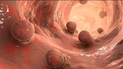 أعراض سرطان القولون عند الأطفال.. نقصان الوزن بشكل ملحوظ