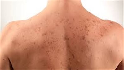 أنواع تصبغات الظهر.. لماذا تحدث؟ 
