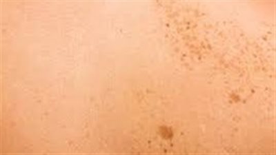 علاج التصبغات الجلدية العميقة.. التقشير الكيميائي والليزر قد يكونا حلا 