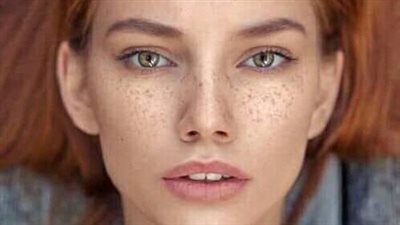 أسباب ظهور النمش.. رمز الجمال عند البعض قد يكون مزعجا لدى الاخر 