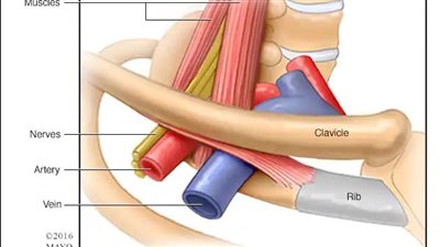 اعراض متلازمة مخرج الصدر وطرق علاجها