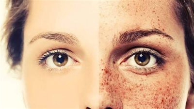 من هم الاكثر عرضة لظهور النمش؟ وما هي طرق علاجه؟ 