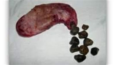 تفتيت حصوات المرارة بالمنظار.. متى يتخذ الطبيب القرار؟