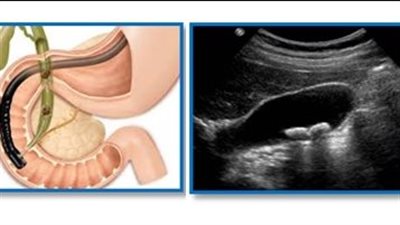 ما فحوصات تشخيص التهاب المرارة؟.. ستة انواع 