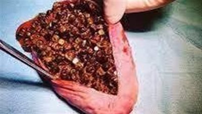 أحجام وانواع حصوات المرارة.. احذر  من كرة الجولف