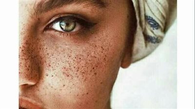 أسباب ظهور بقع الوجه فجأة وطرق العلاج
