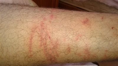 مع موسم المصايف.. لسعة قنديل البحر هل هى خطيرة؟