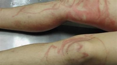 إسعافات لسعة قنديل البحر.. لا تلجأ للخرافات 