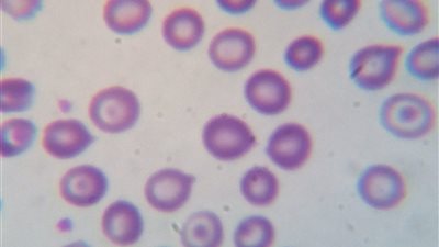 أعراض أنيميا البحر المتوسط ووسائل التشخيص