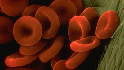 طرق علاج أنيميا البحر المتوسط.. الجيني أحدثها