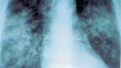 داء الساركويد.. ما هو واسبابه واعراضه؟