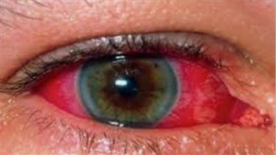 الالتهاب القزحي.. الاعراض والانواع والاسباب وطرق العلاج