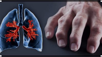 ما هو الروماتويد المفصلى؟ وما أبرز أعراضه؟