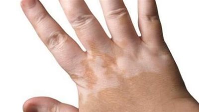 مرض البهاق.. اهم اعراضه واسبابه الشائعة 