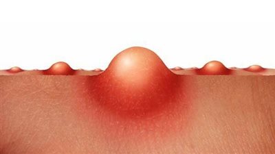 غذاء المصابين بحب الشباب.. البطيخ والبرتقال لمقاومة البثور السوداء