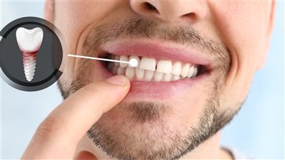 عملية زراعة الأسنان.. الخطوات والممنوعات والنصائح اللازمة لنجاحها