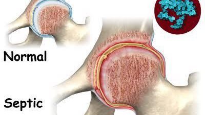 التهاب المفاصل الصديدي أو البكتيري.. من هم الأكثر عرضة للاصابة به؟