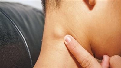 انتفاخ الغدد اللمفاوية.. ما علاقته بالسرطان؟