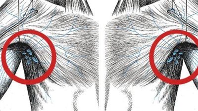 كيف يتم تشخيص انتفاخ العقد اللمفاوية؟.. الأشعة المقطعية تسهل الامر 