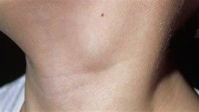 بالشاى والنعناع والخروع.. علاج التهاب الغدد اللمفاوية بالأعشاب