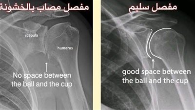 انواع خشونة مفصل الكتف.. انواعها وابرز الاعراض
